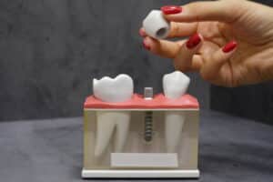 Do Dentures Cover the Roof of Your Mouth