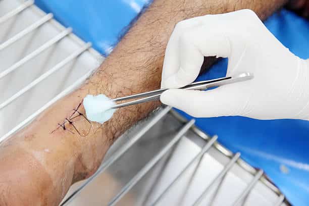 Does Urgent Care Do Stitches